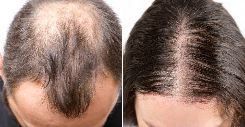 A man and a woman are both suffering from hair loss problems.