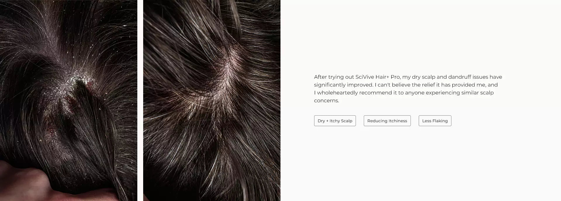 SciVive Hair+ Pro improves the dandruff issues
