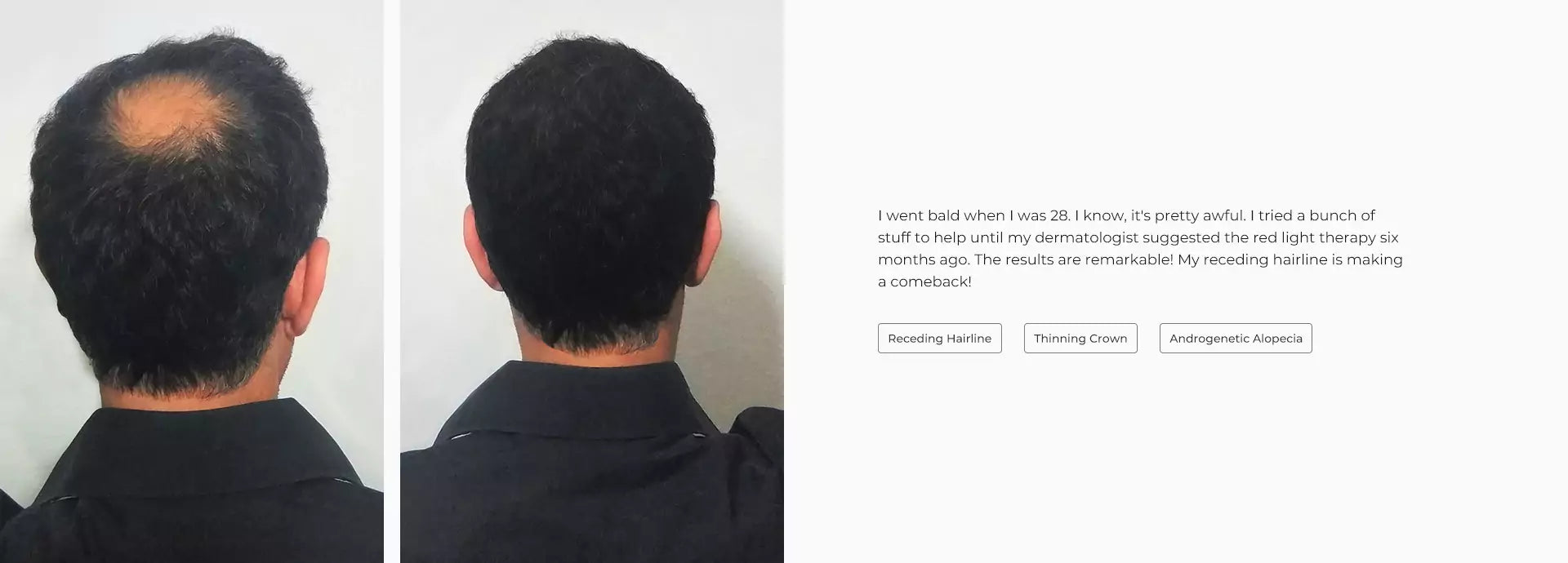 man hair results SciVive Hair+ Pro before and after